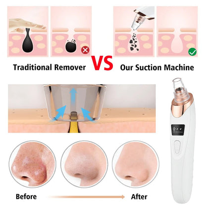 5 in 1 Black Head Remover machine